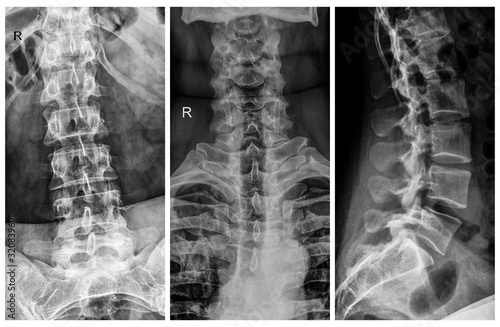 x-ray film of human spine