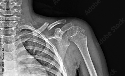 x- ray of the shoulder joint with a broken collarbone