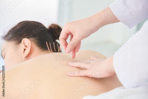Hands of therapist doing acupuncture at patient back ,Alternative medicine concept.