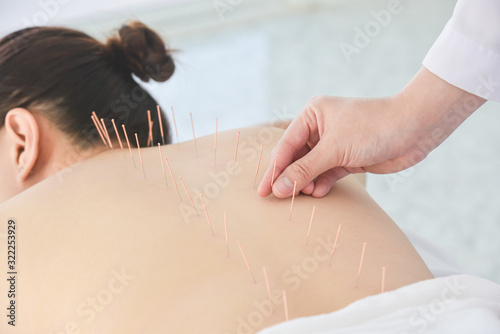 Close up of hands doing acupuncture with at patient back ,Alternative medicine concept.