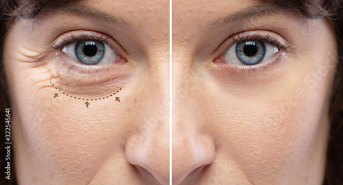 Before and after a rejuvination treatment, wrinkles and crow's feet removal Lines and arrows shows blepharoplasty zone