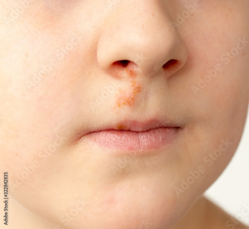 face of boy with herpes on his nose close up, Herpes simplex virus