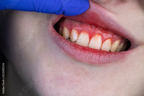 Gum bleeding and inflammation close up. A man examined by a dentist. The diagnosis of gingivitis