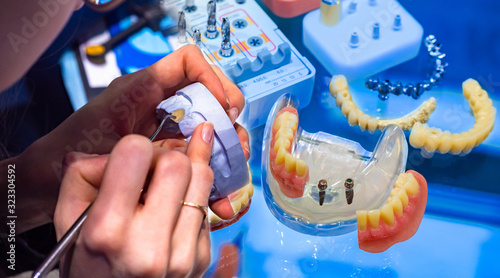 Dentist at work. Working with the patient's jaw layout. Installation of dental implants. Dental implant procedure. Manufacturing of removable prostheses. Prosthetics. The dentist's work.