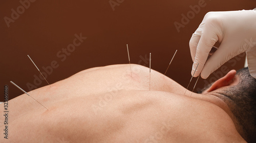 Close-up needle in the back of man during acupuncture procedure on a brown background. Acupuncture. Macro