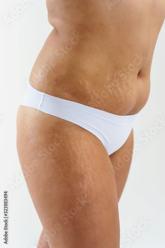 Woman showing her cellulite and stretch marks. Problems of obesity, women body, fat burning