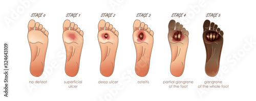 Diabetic Foot. Stages of defeat. Ulcers, skin sores on foot