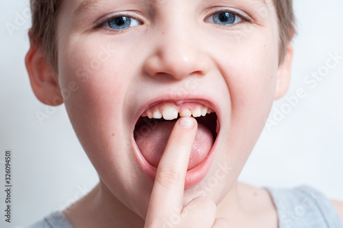 children's teeth, loss and fingers pointed at the incisor teeth, children's mouths of child close up, incisor milk tooth missing of kid