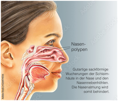 Nasenpolypen