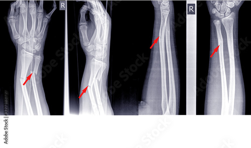 X-ray image right of wrist joint, shows fracture of the distal radius and ulna