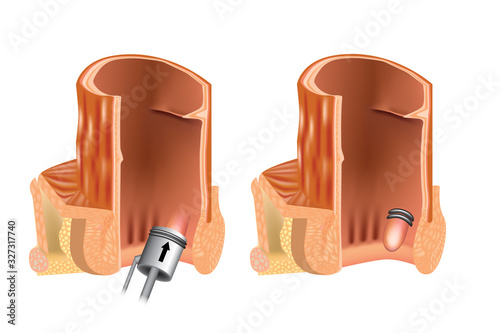 Rubber band ligation of hemorrhoid (latex ligation). RBL. Anoscope