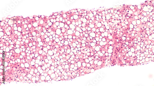 Photomicrograph of liver biopsy histology (pathology) showing steatosis ("fatty liver"), which may be associated with diabetes mellitus, alcohol abuse, or toxins. 