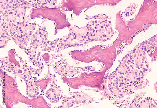 Metastatic prostate cancer: Photomicrograph of bone biopsy showing metastasis of prostatic adenocarcinoma within the marrow space. 