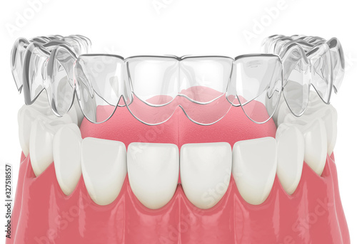 3d render of invisalign removable retainer with lower jaw