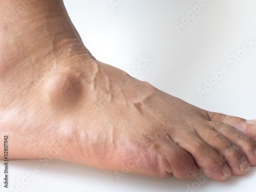 Big ganglion cysts,a sac of jellylike fluid,is on the right foot of man put on the white background.