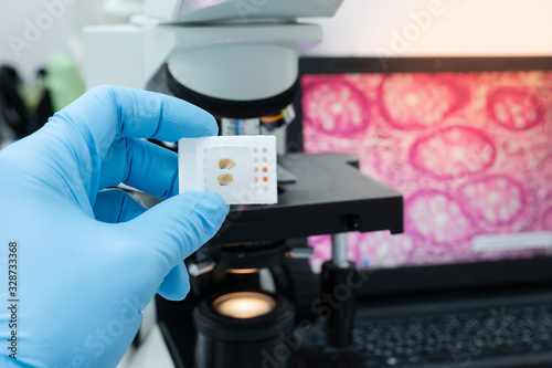 Scientist wear blue glove holding human tissue block and out of focus modern microscope with digital camera and computer monitor show glandular image.Medical pathology and cytology technology 