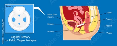 Pelvic floor prolapse type uterine uterus biofeedback pelvic floor treatment stage degree Kegel exercise surgery surgical therapy disorder cystocele urethrocele vaginal vault enterocele urethral exam