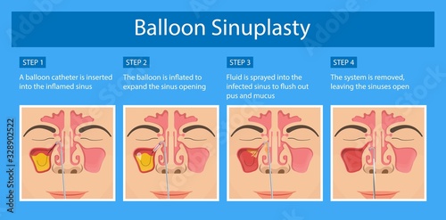 Sinusitis medical disease treat sinuses allergies surgical drug smart ENT endoscopy diagnose