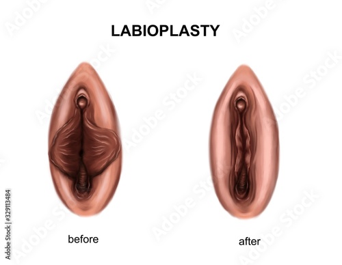 Illustration of the labioplasty. Before and after surgery
