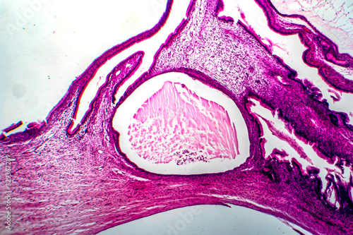 Ovarian mucinous cystadenoma, a benign tumor of ovary, light micrograph, photo under microscope