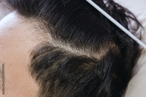 Close up of a hair dandruff , Black hair 
