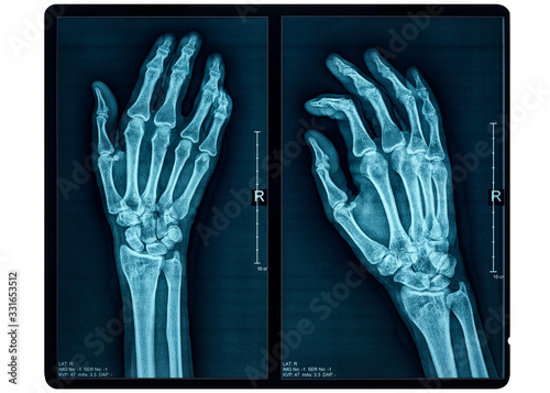 Hand X-ray