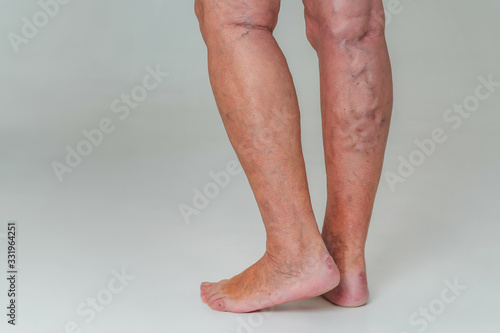 Varicose veins in an elderly woman. Inflamed dilated veins in the legs. Varicose veins in the late advanced stage.