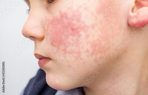 Boy with red cheeks- diathesis or allergy symptoms. Redness and peeling of the skin on the face. 