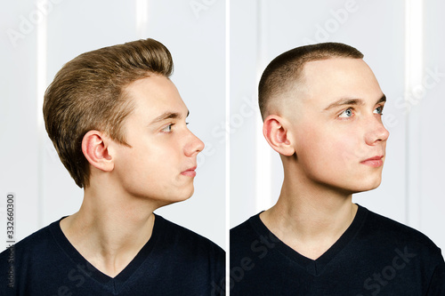 man before arter haircut with hair loss: bald and pompadour, transplant and transformation in profile fade side