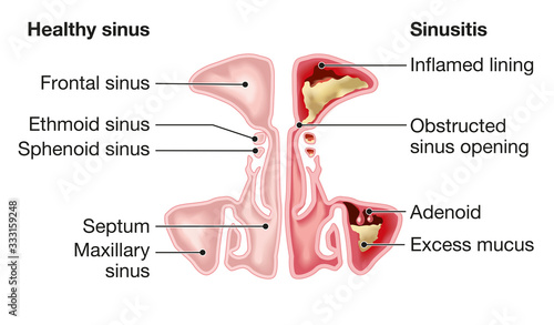 Healthy sinus and sinusitis, medical illustration, labeled