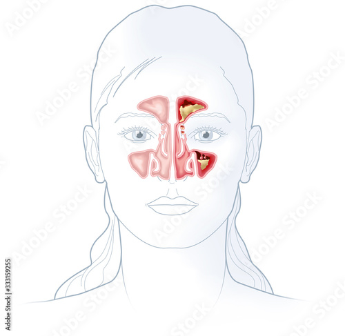 Healthy sinus and sinusitis, medical illustration