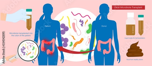 Fecal microbiota transplant (FMT) stool transferring bacteria microbes 