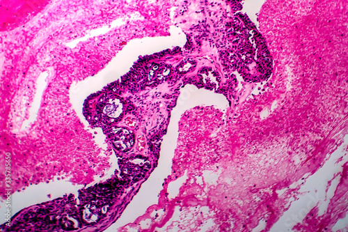 Papillary serous ovarian adenocarcinoma, light micrograph