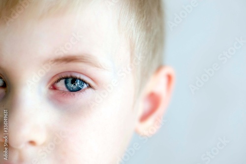 Eye of infant with inflammation of the cornea of the eye. Blond boy with blue eyes. Conjunctivitis in a child. The harm of watching your computer and TV for a long time.
