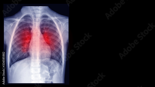 Film X-ray chest radiograph (CXR) show perihilar infiltration and pleural thickening. This cause form viral pneumonia and bronchitis infection disease. Medical imaging investigation concept