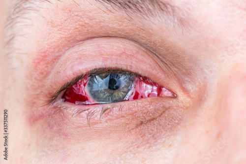 postoperative heavy inflamed eye close-up shot with selective focus