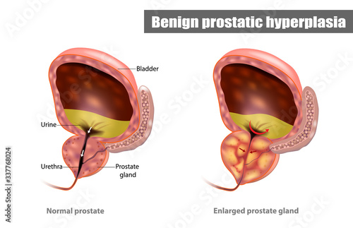 Benign prostatic hyperplasia (BPH), also called prostate enlargement