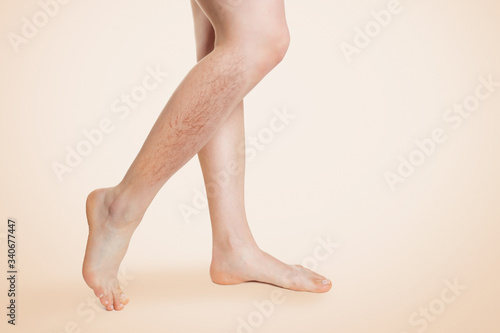 Smooth female legs, with varicose veins and swelling on the lower leg. Beige background. Copy space.The concept of varicose disease