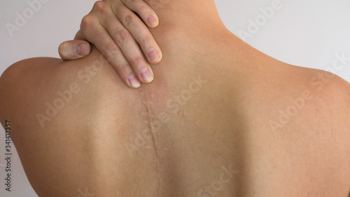 The scar on the bare back of a woman. Scoliosis of the spine. Medical content.
