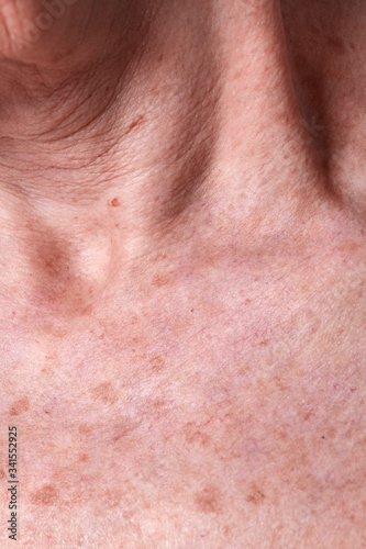 Aging female skin with melasma spots