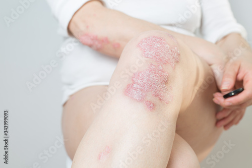 Acute psoriasis on the knees ,body ,elbows is an autoimmune incurable dermatological skin disease. Large red, inflamed, flaky rash on the knees. Joints affected by psoriatic arthritis.