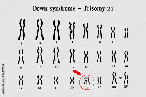 Karyotype of Down syndrome (DS or DNS), also known as trisomy 21, is a genetic disorder caused by the presence of all or part of a third copy of chromosome 21