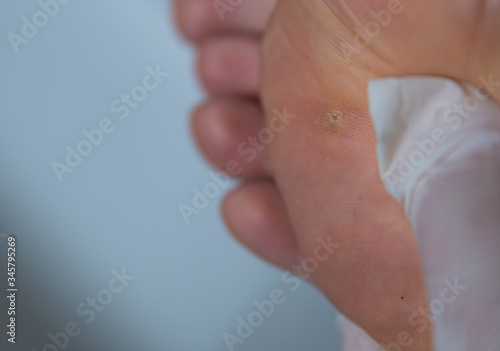 Close up shot of a warty Caucasian man's foot. The fingers of the hand inspect the skin near the infected area.