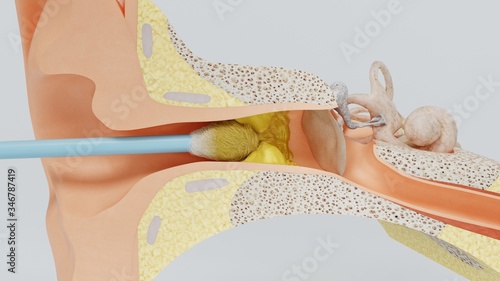 3d render ear cleansing ear stick. cleansing earwax with an ear stick