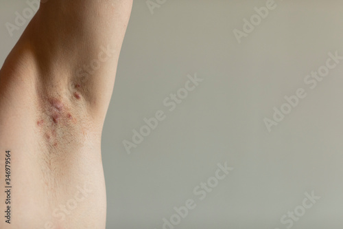 A patient diagnosed with Crohn’s disease with hidradenitis suppurativa under his armit with visible red painful fistulas. Irritated skin and hair follicles, abcess. Close up