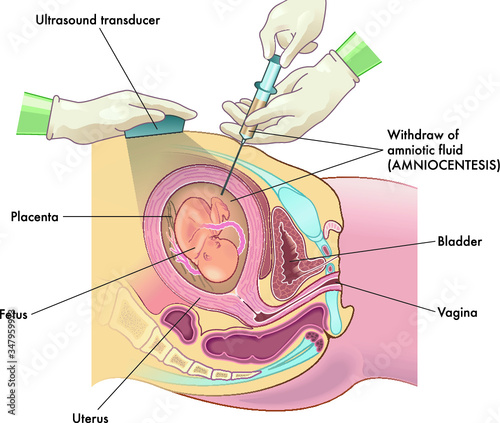 Medical illustration of Amniocentesis procedure with annotations