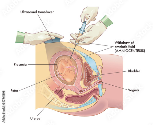 Medical illustration of Amniocentesis procedure with annotations.