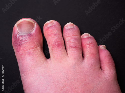 A man's toes showing what looks like a rash with red blotchy skin. A common side effect of Covid-19 often referred to as "Covid toe"