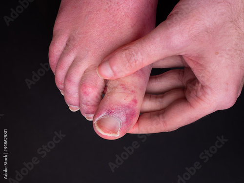 A white man holding his toes, showing what looks like a rash with red blotchy skin. A common side effect of Covid-19 often referred to as "Covid toe"