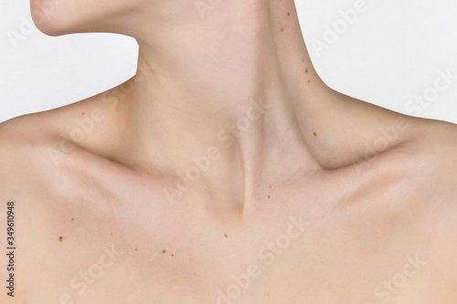 necklace of moles, moles on the neck, collarbone and breast of a young girl, concept of skin care, beauty and risks of papillomavirus cancer